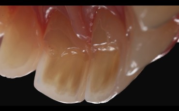 Starcie zębów - deprogramacja, diagnostyka, planowanie, odbudowa, ekwilibracja