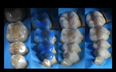 Starcie zębów - deprogramacja, diagnostyka, planowanie, odbudowa, ekwilibracja