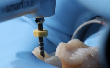 Endodoncja mikrochirurgiczna