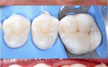 STYLE ITALIANO bez tajemnic, czyli detale odbudowy zębów bocznych